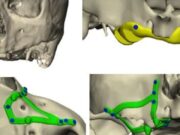 La planificació digital millora la precisió dels implants subperiòstics personalitzats