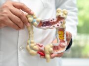 Fins al 50% dels casos de càncer de còlon es poden prevenir amb hàbits saludables
